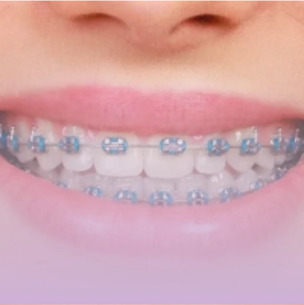 Ortodontia e aparelho dentário na Contreras Odontologia, em Curitiba