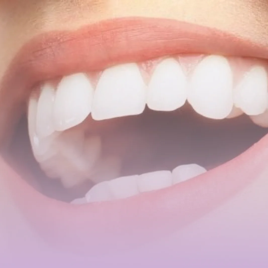 Clareamento dental na Contreras Odontologia, em Santa Felicidade, Curitiba