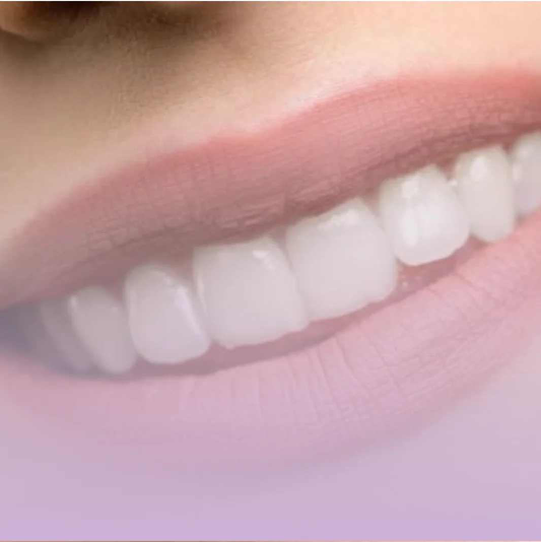 Facetas de porcelana e de resina na Contreras Odontologia, em Curitiba