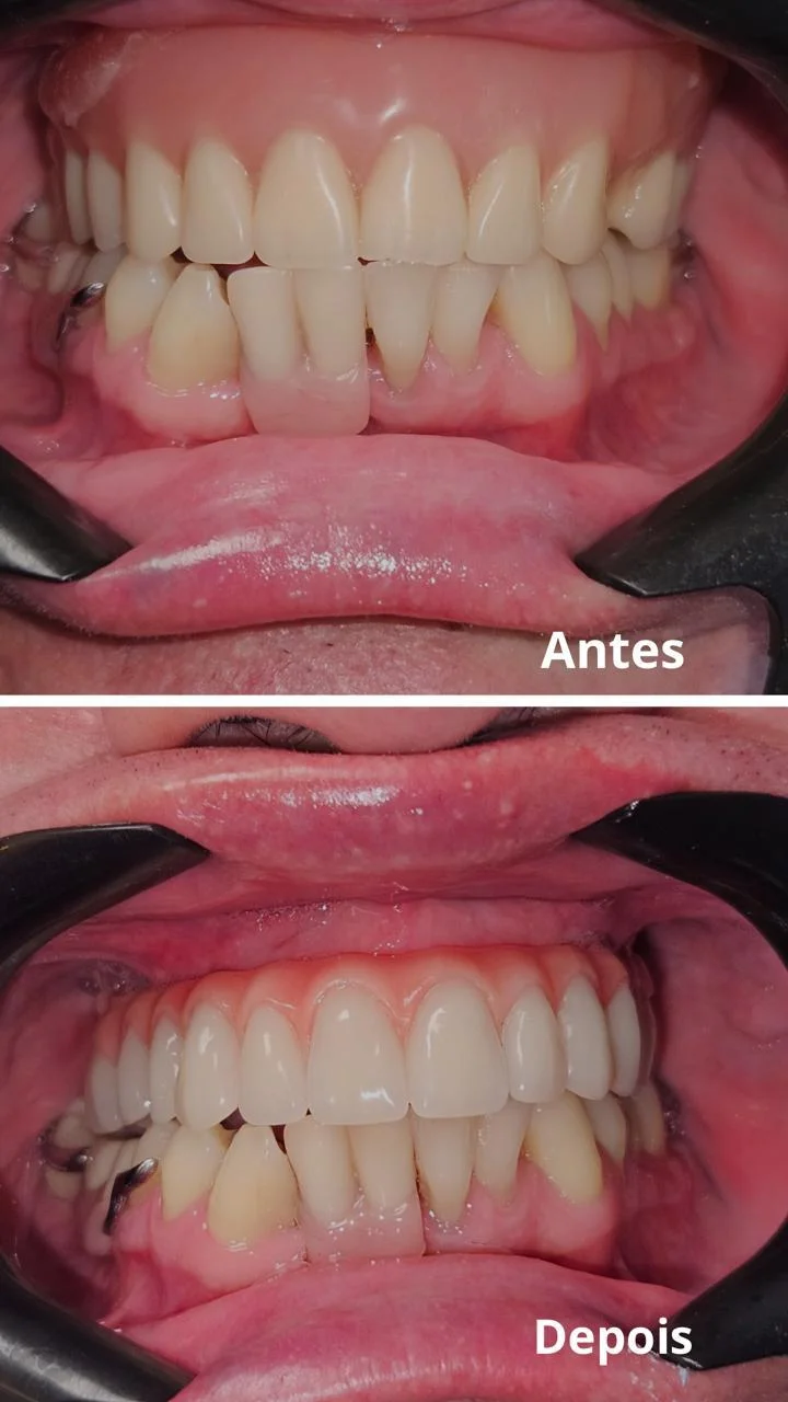 Antes e depois de reabilitação dos dentes superiores com prótese, caso atendido na Contreras Odontologia