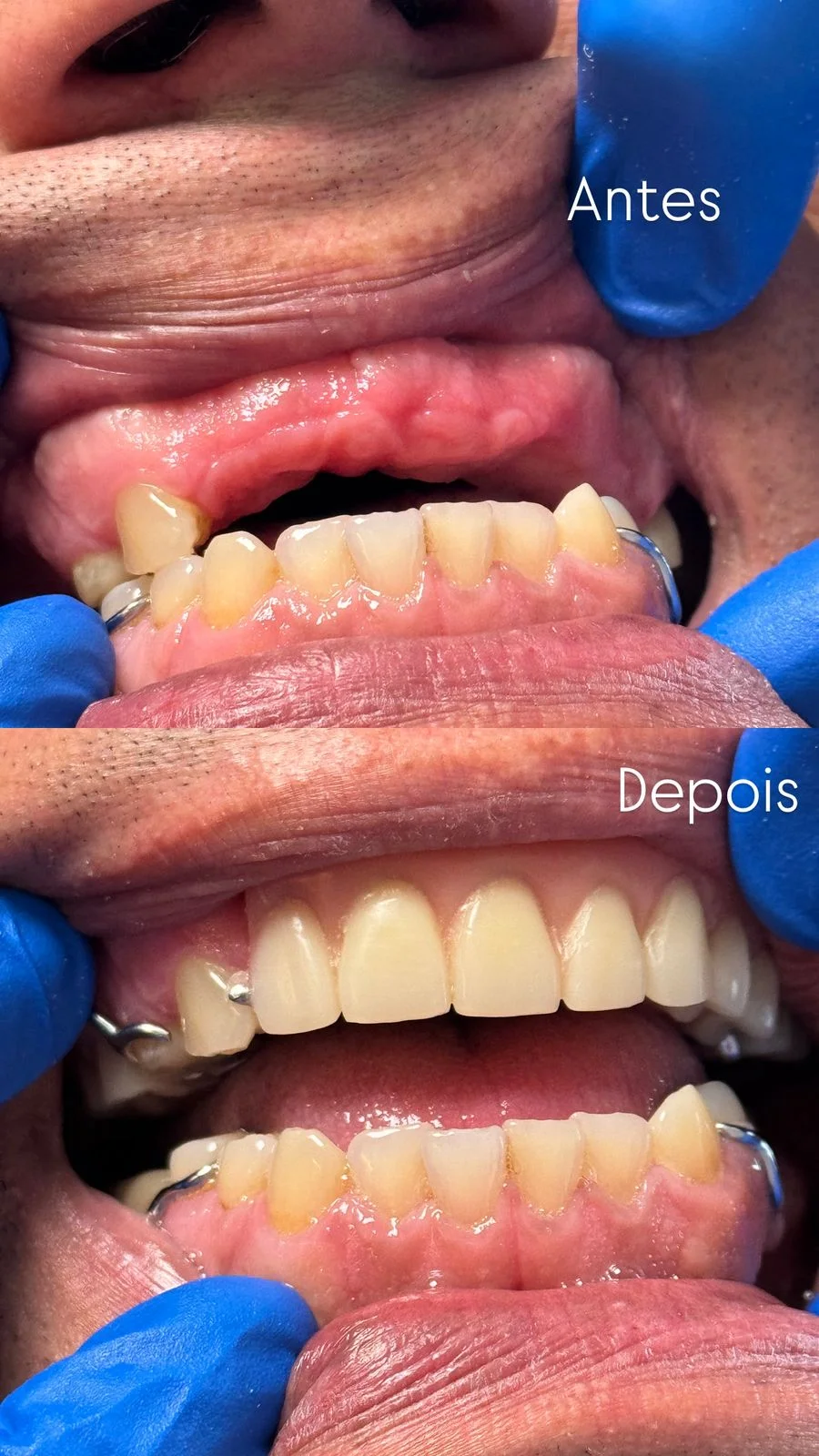 Antes e depois de reabilitação com prótese dentária superior, caso atendido na Contreras Odontologia em Curitiba